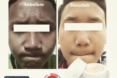 Waspada Kosmetik Ilegal Ancam Nyawa: Picu Kanker, Kerusakan Ginjal Permanen, hingga Cacat Janin